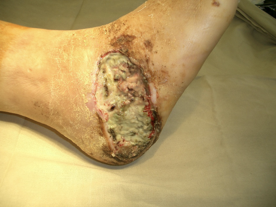 Rare causes of acute purulent-inflammatory lesions of pararectal tissue and Fournier’s gangrene